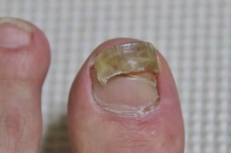 足の爪を除去する時期