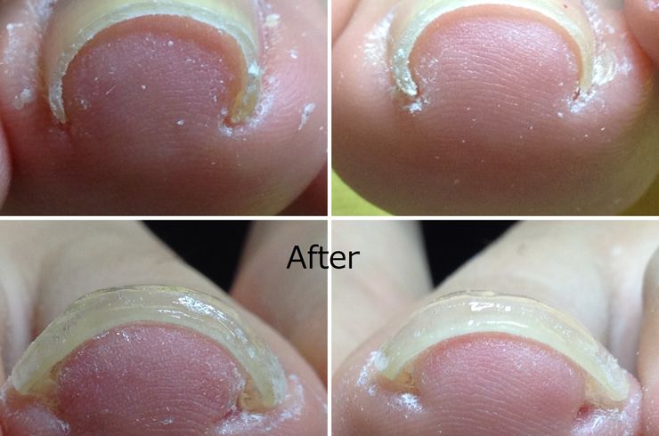 巻き爪専門 京都の足トラブル専門サロン