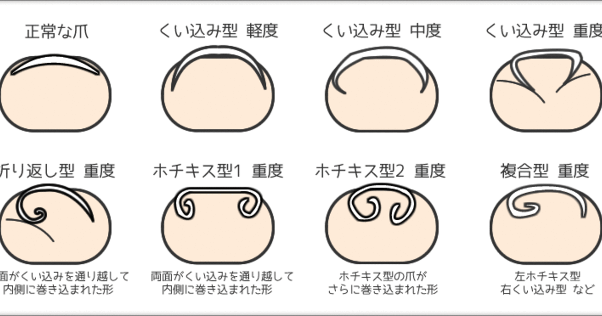 巻き爪はその状態によっては早い目の対策が必要