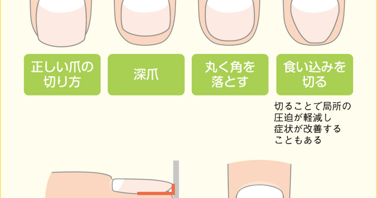 深爪が原因でトラブルが 京都 巻き爪専門